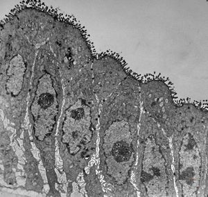 jejunum - celiakia jejunum - celiakia
